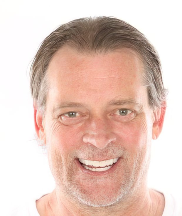 Dr. Valenzuela's patient after dental implants