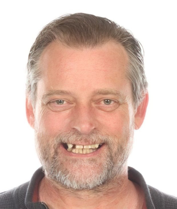 Dr. Valenzuela's patient before dental implants