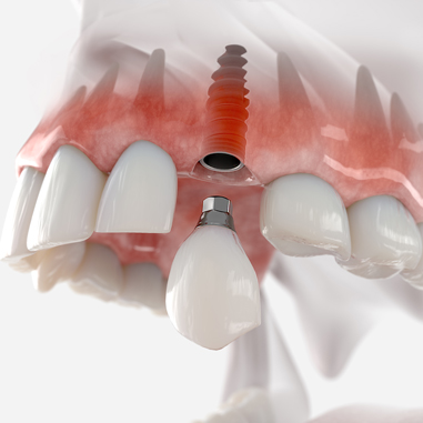 Dental Crowns