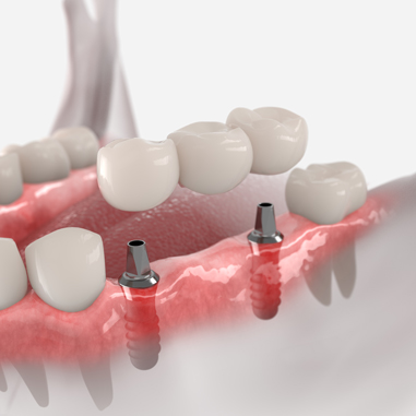 Dental Bridges