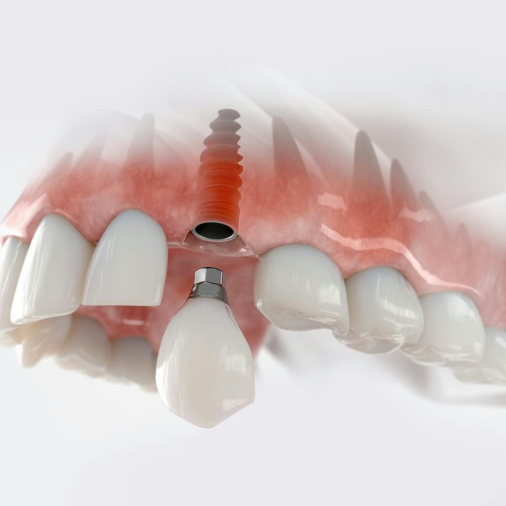 Implant-supported crown