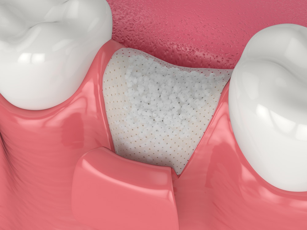bone grafting
