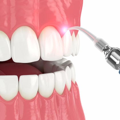 illustration of laser dentistry