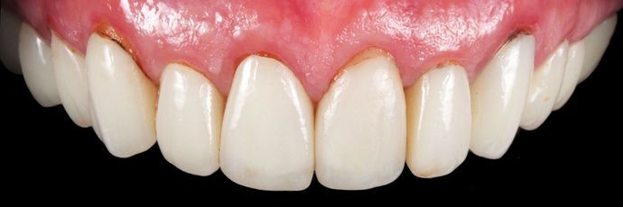 Before same-day crowns