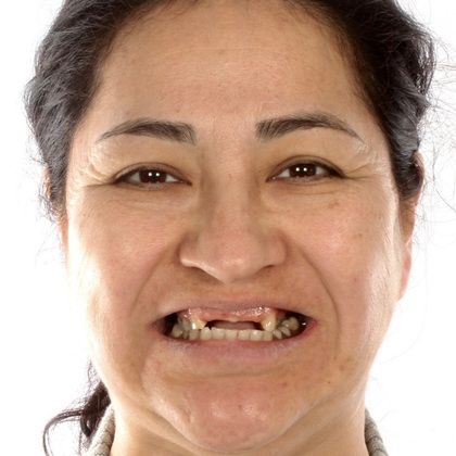 Dr. Jose Valenzuela's patient with missing and damaged teeth