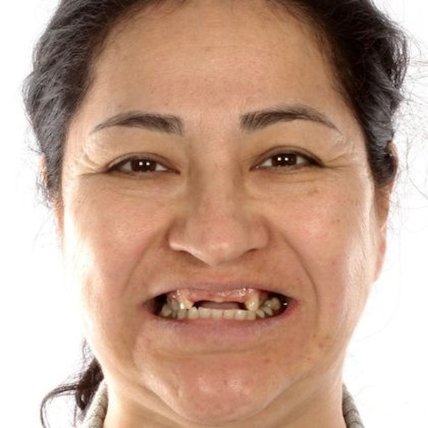 Dr. Jose Valenzuela's female patient before  dentures