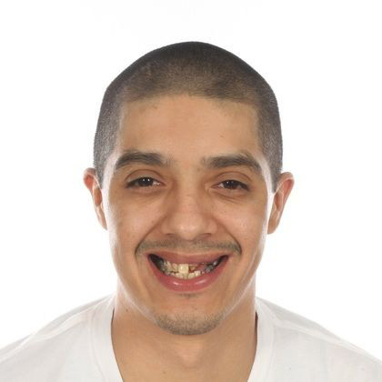 Dr. Jose Valenzuela's patient before tooth extraction