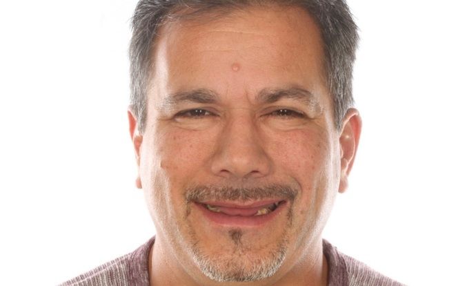 Dr. Jose Valenzuela's patient before All-on-4 dentures