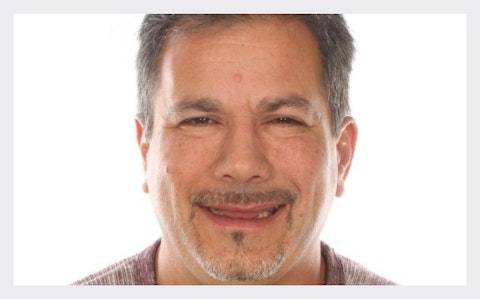 Los Algodones patient Before All on 4 Dentures