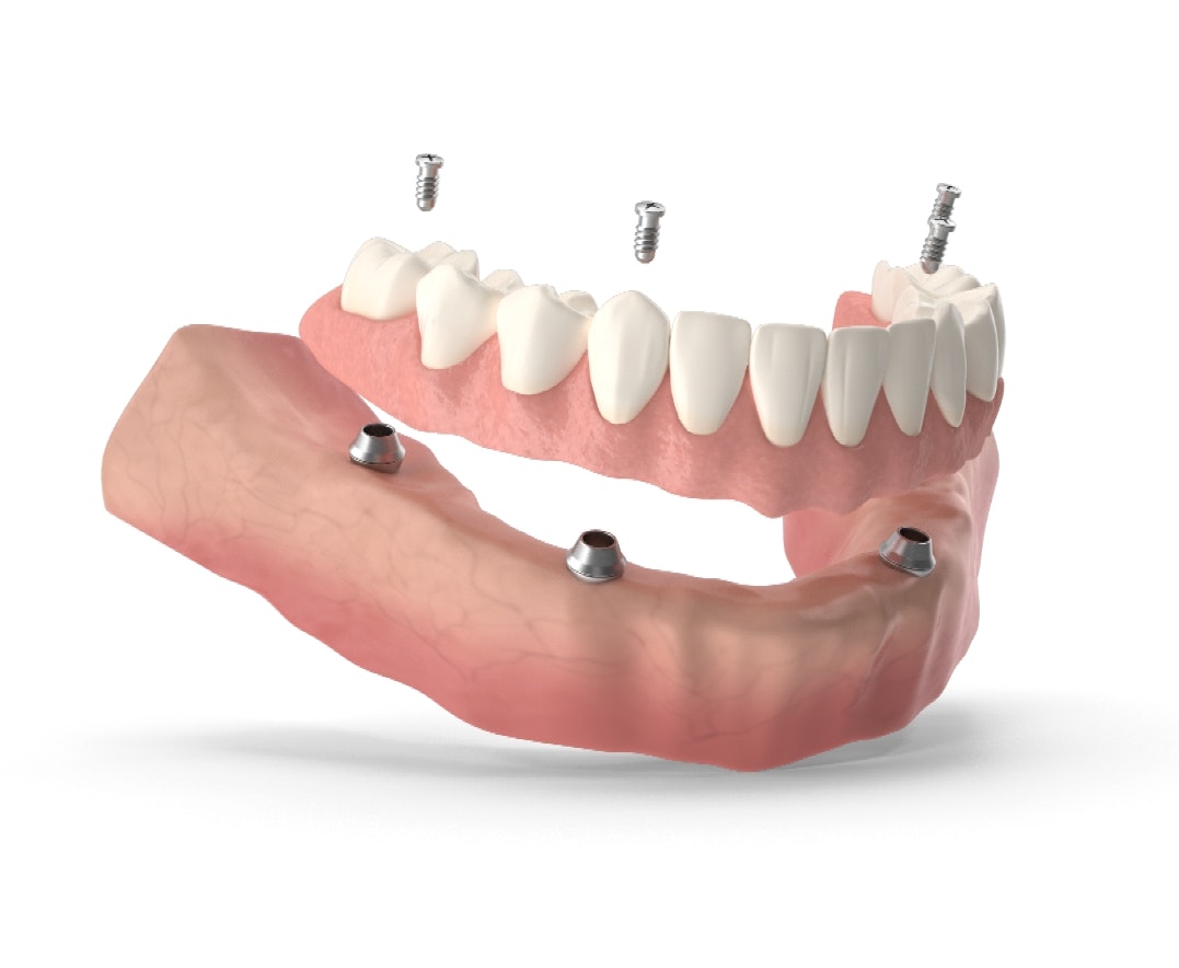 3D Rotation of All on Four Dentures