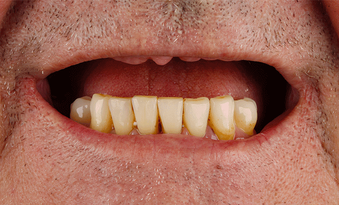 Smiles of patients with varying degrees of tooth loss