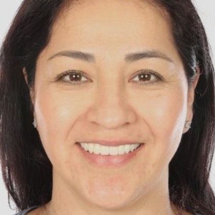 After implants in Los Algodones