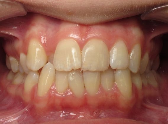 Before Invisalign