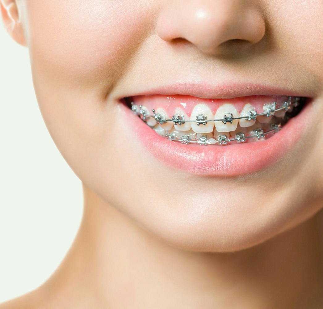 Close-up of a patient with braces smiling