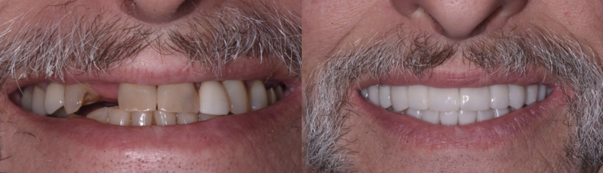Before and after dental implants and crowns