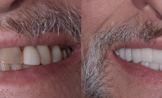 Before and after dental implants and crowns