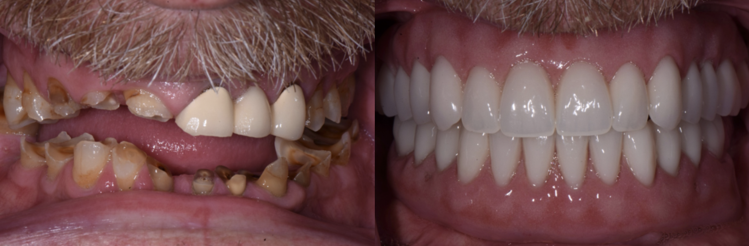 Before and after full mouth reconstruction
