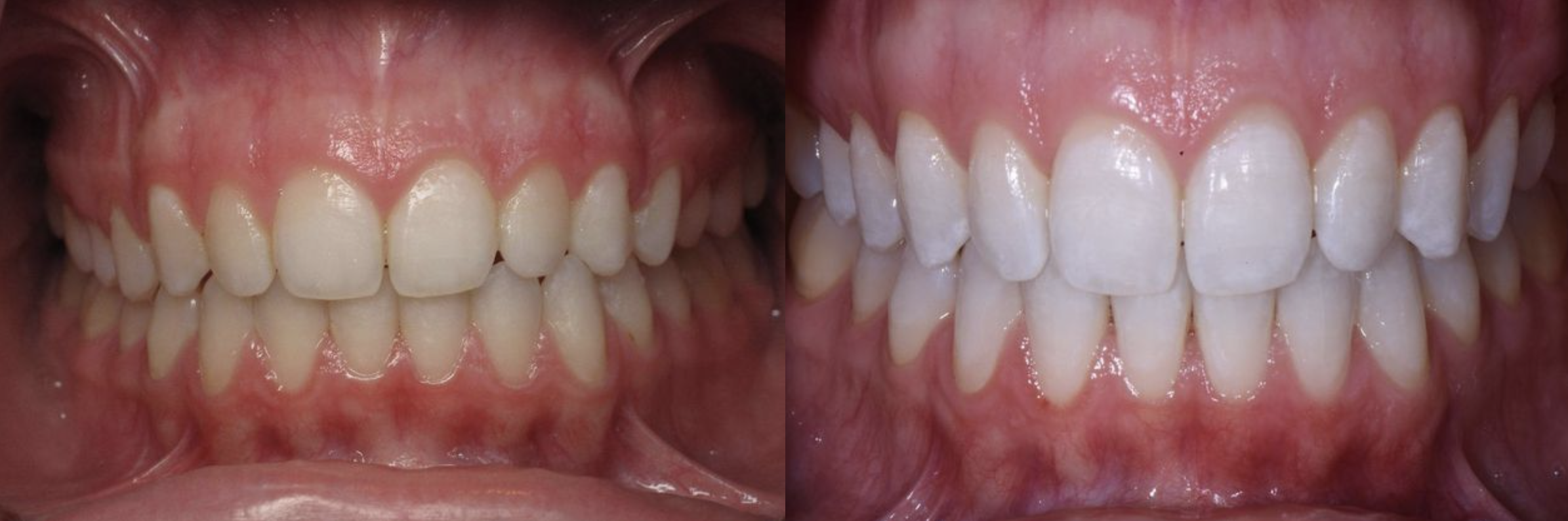 Before and after teeth whitening