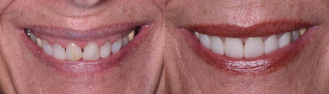 Dental crown treatment before and after