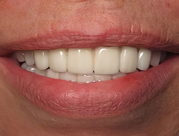 After dental implants
