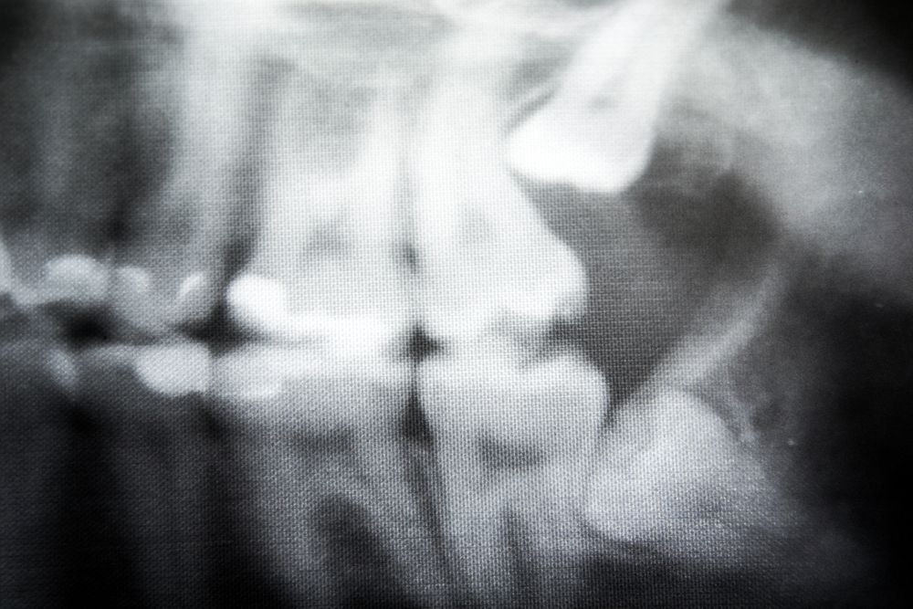 X-ray image of an impacted tooth in need of wisdom tooth removal.