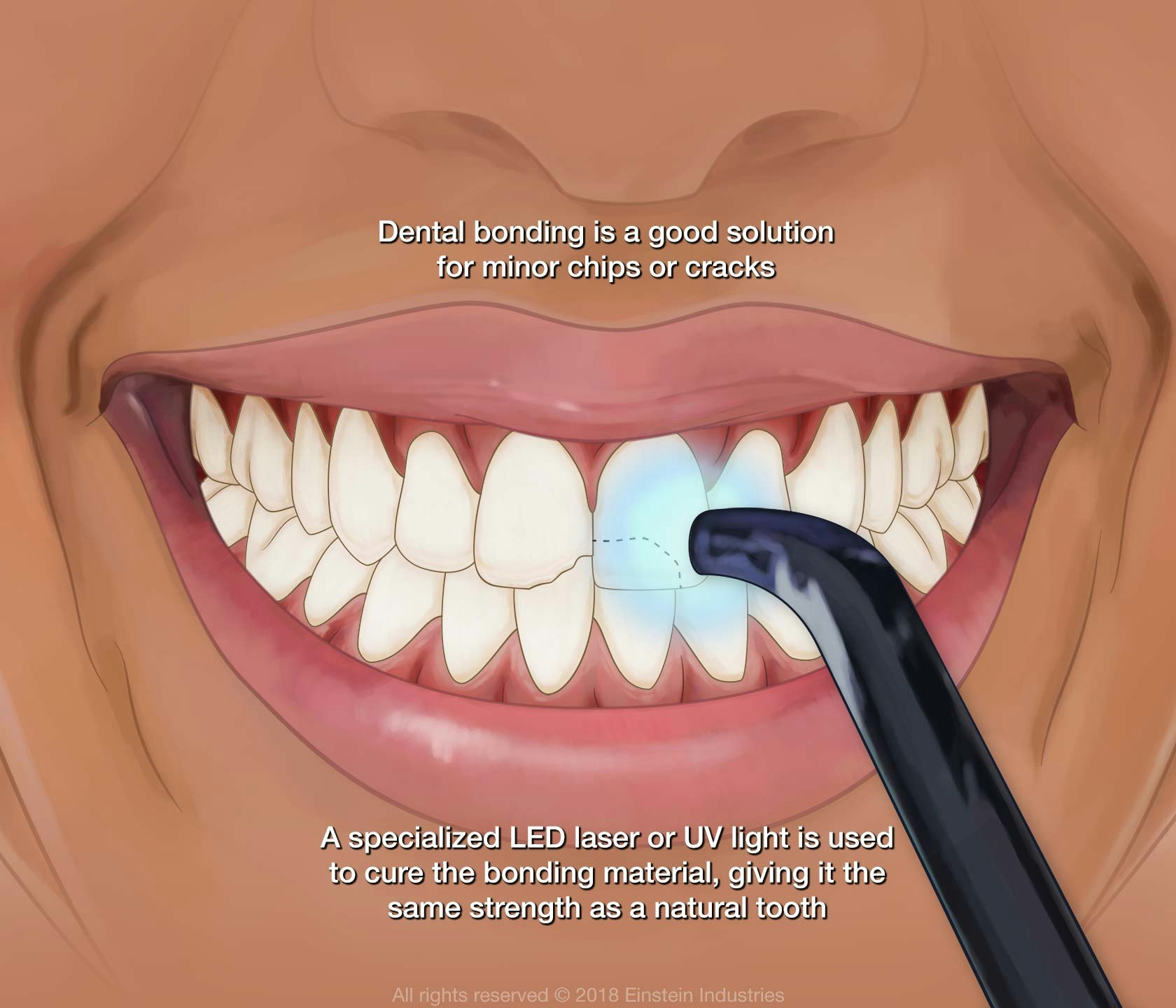 An illustration of the dental bonding process