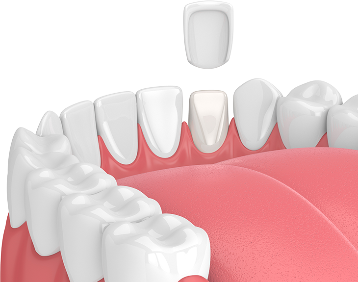 dental veneers