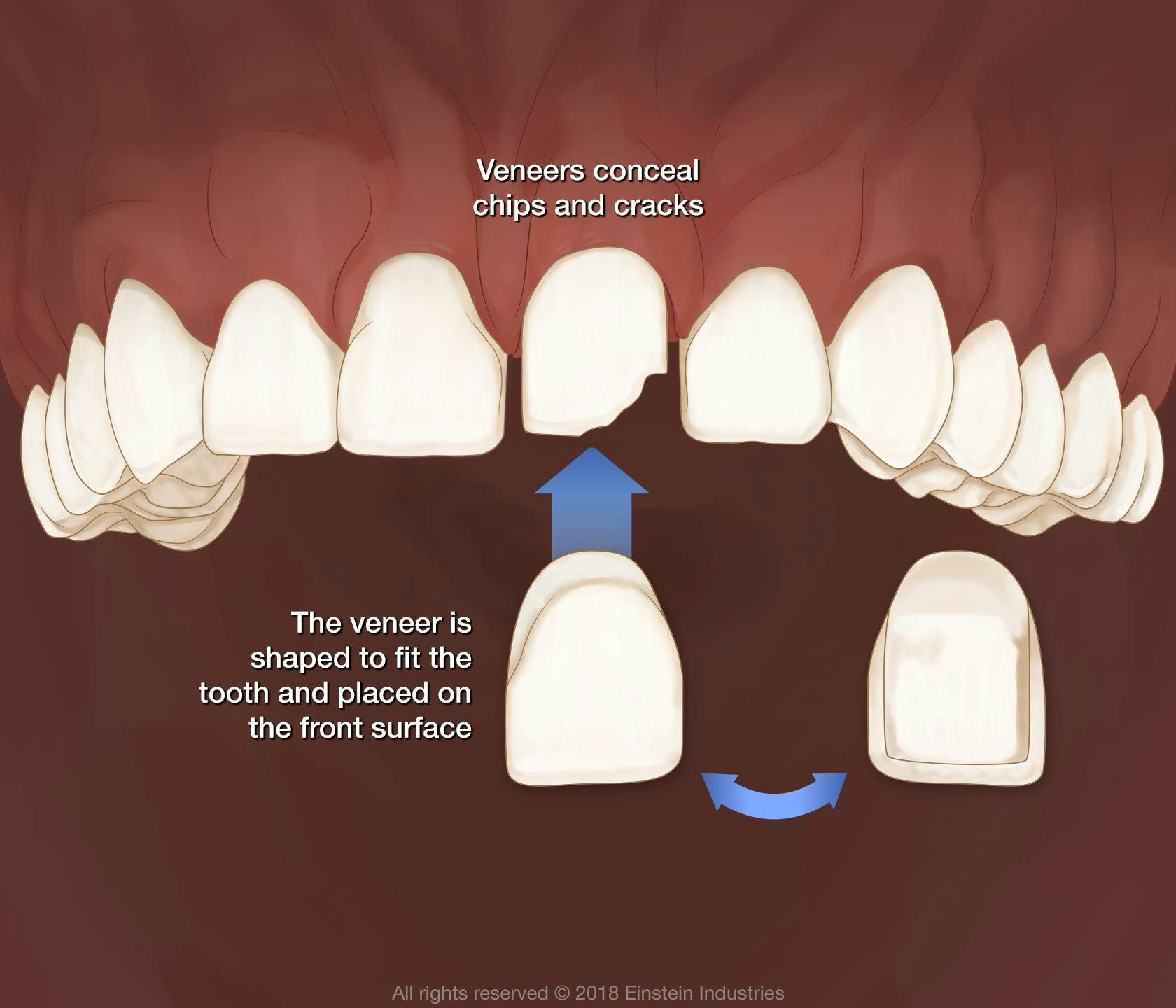 graphic of veneer fitting over damaged tooth