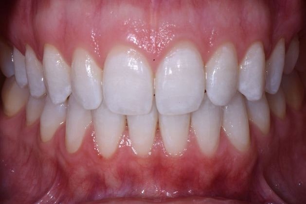 After teeth whitening