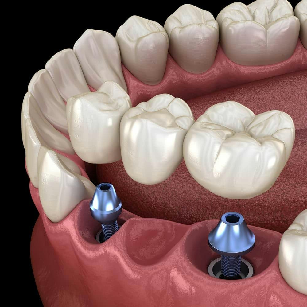 An illustration of an implant-supported dental bridge
