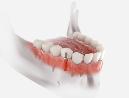 Implant-supported crown