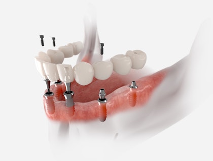 implant-supported-denture