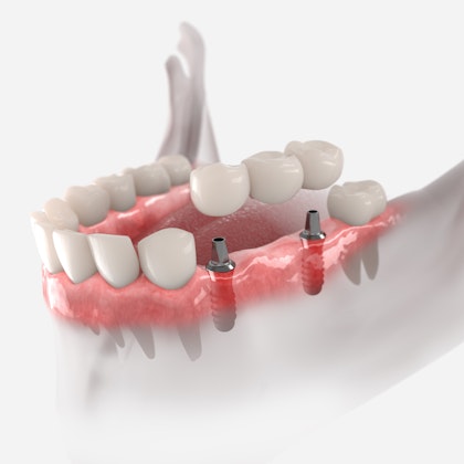 Implant-supported bridge
