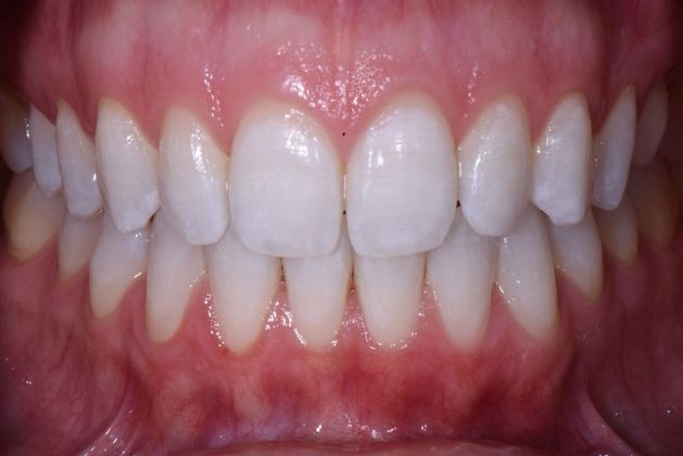 after teeth whitening