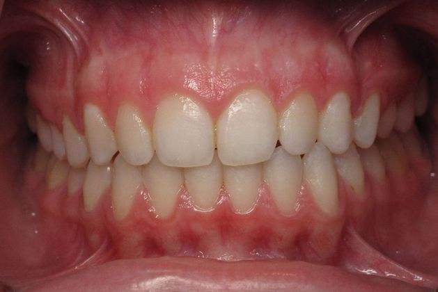 before teeth whitening