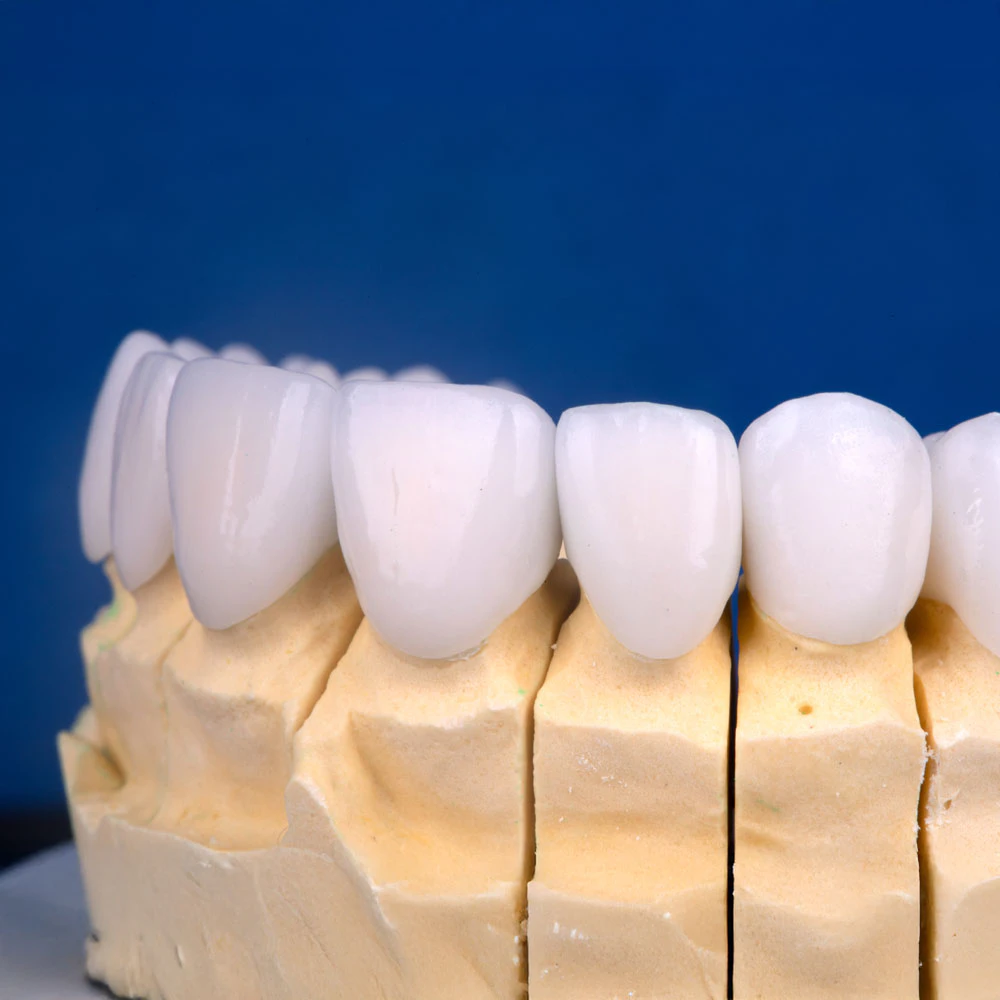 veneers on a model dental arch