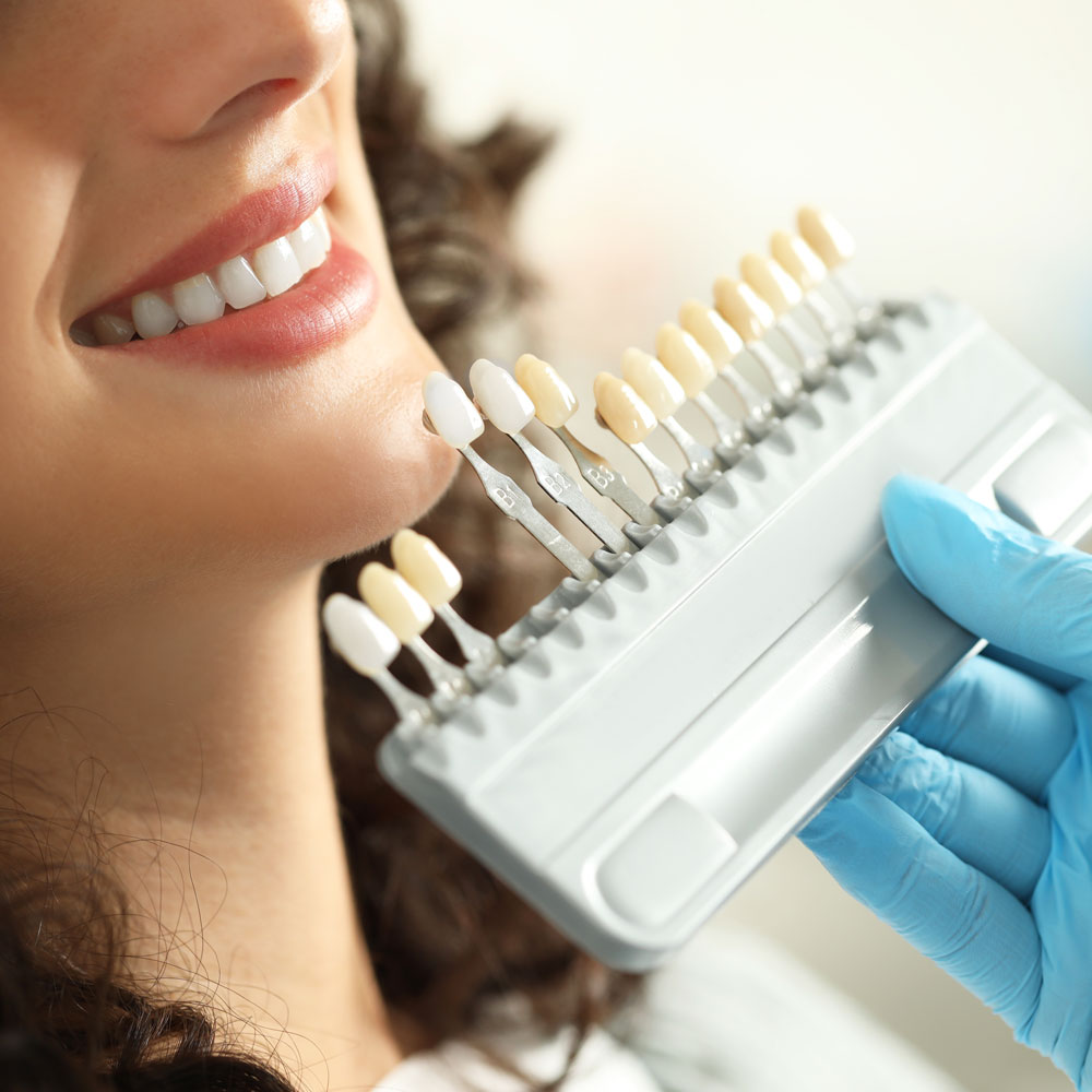 Veneer shade guide next to woman's smile