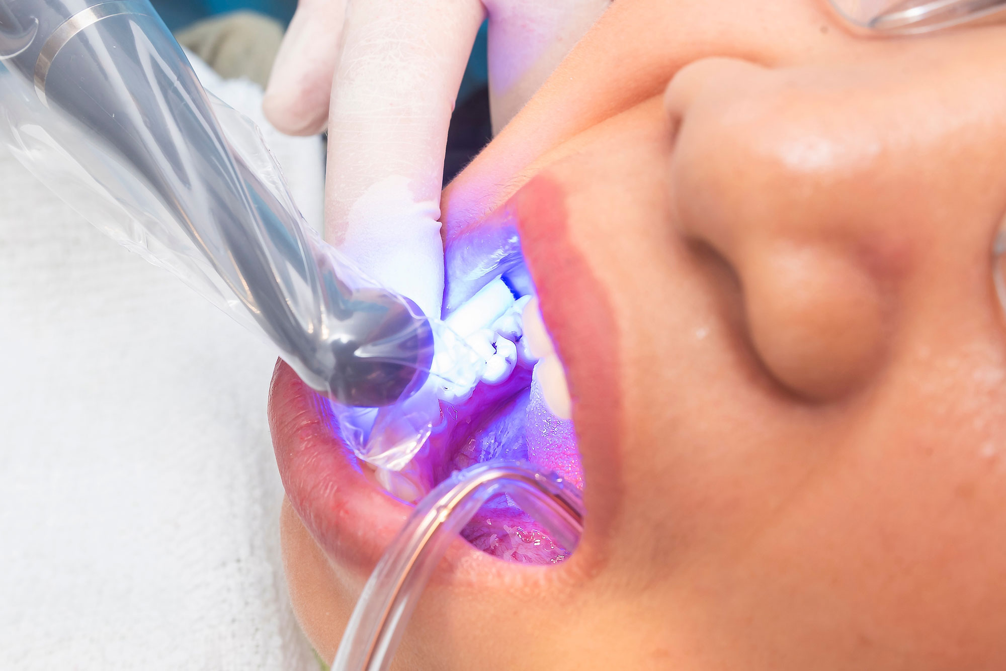 Dental bonding procedure