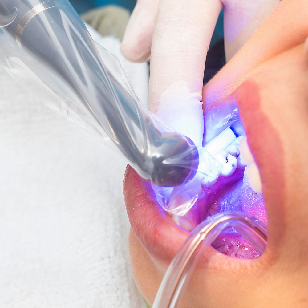 Dental bonding procedure