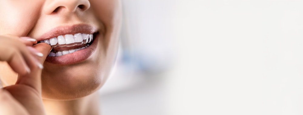 woman putting in clear aligner