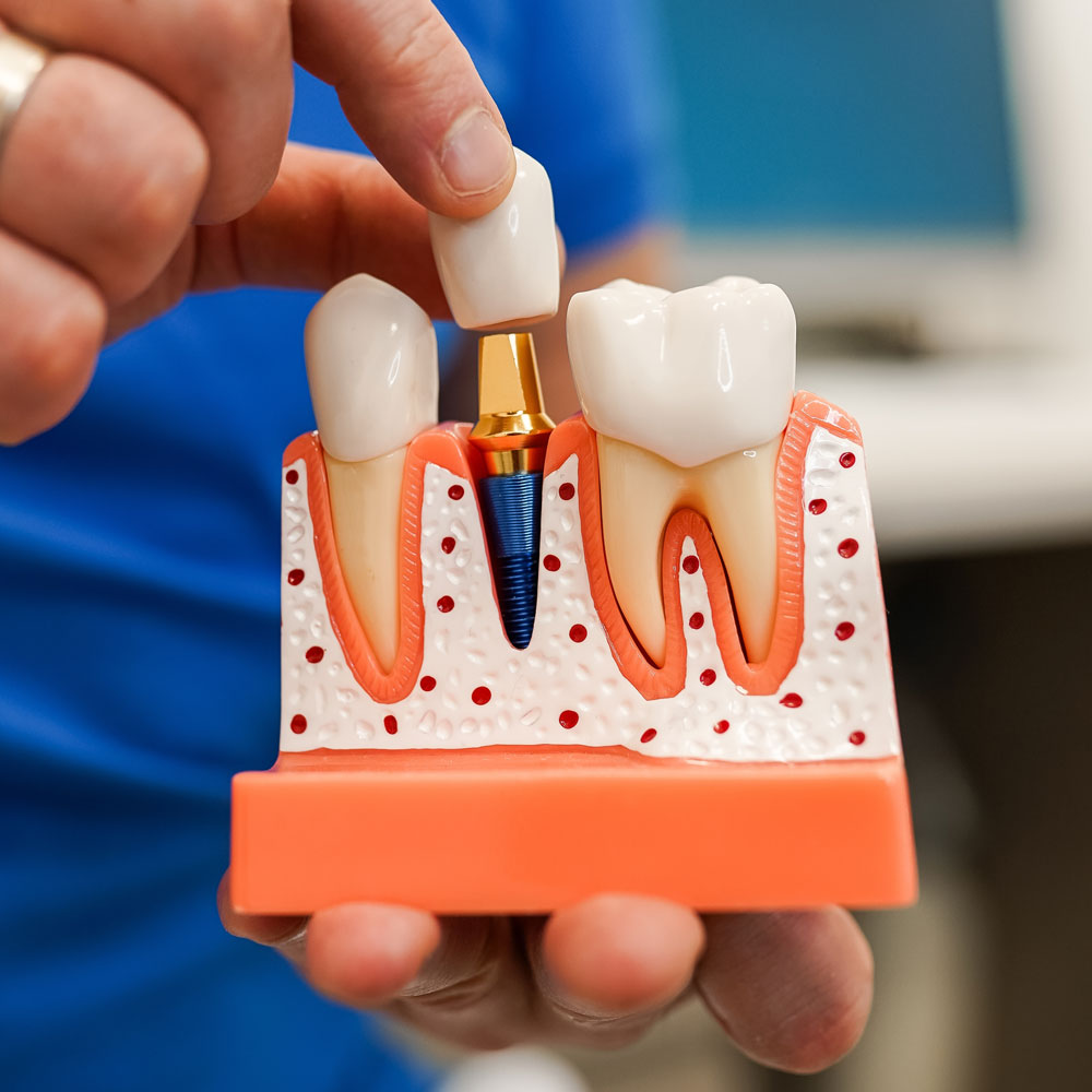 model of dental implant