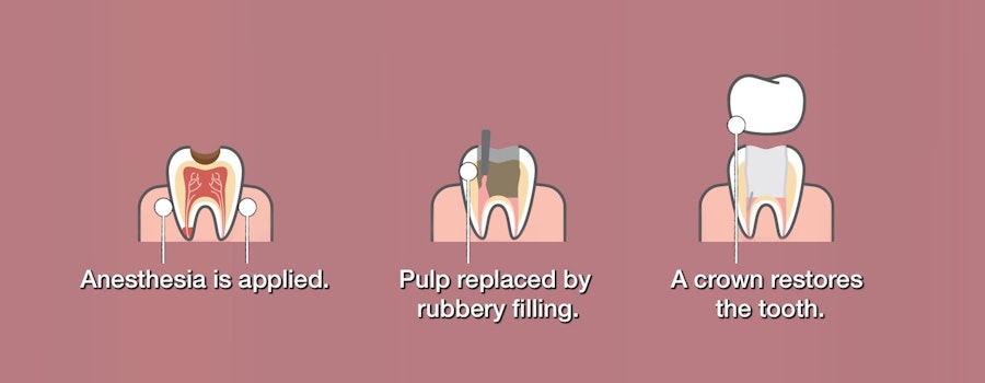 Root canal diagram