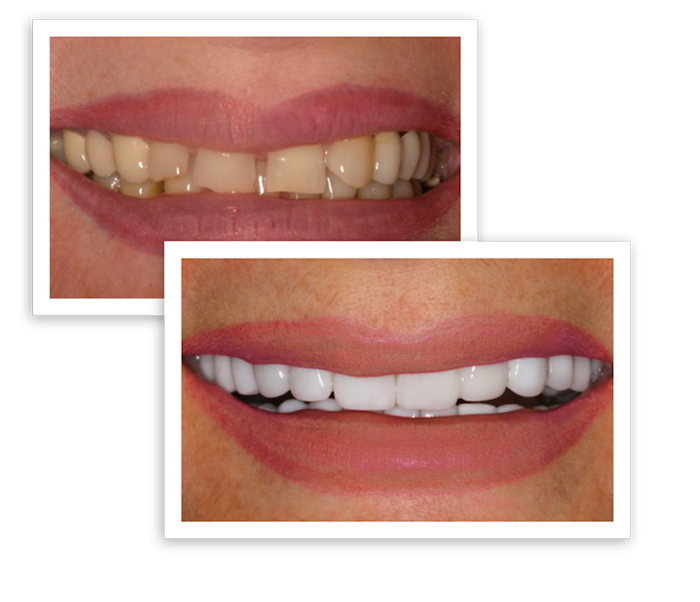 before and after smile makeover