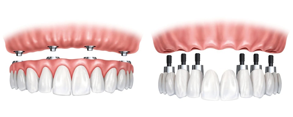 All-On-4 vs. Traditional Implants