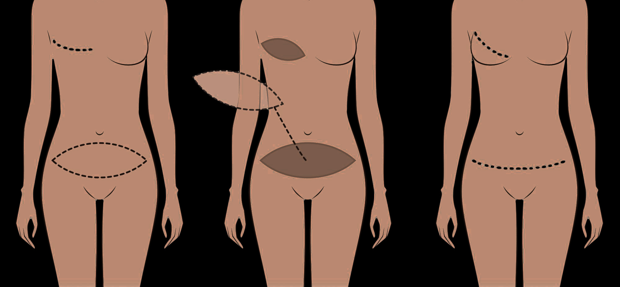 Mastectomy Types: Illustrations, Procedure, Recovery, Cost & More