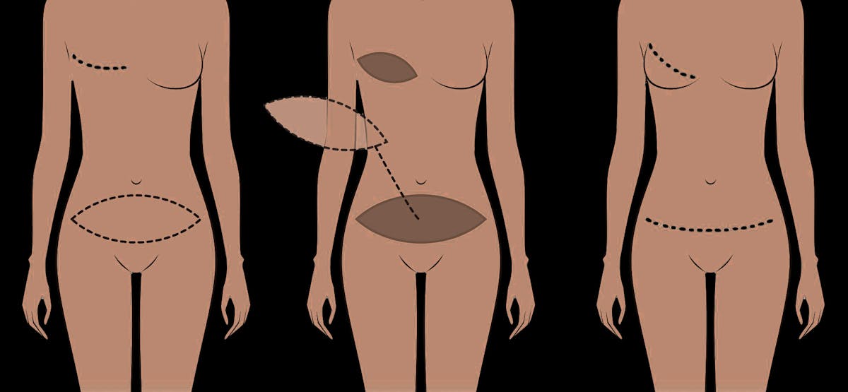 Schematic of the DIEP flap reconstructive surgery and