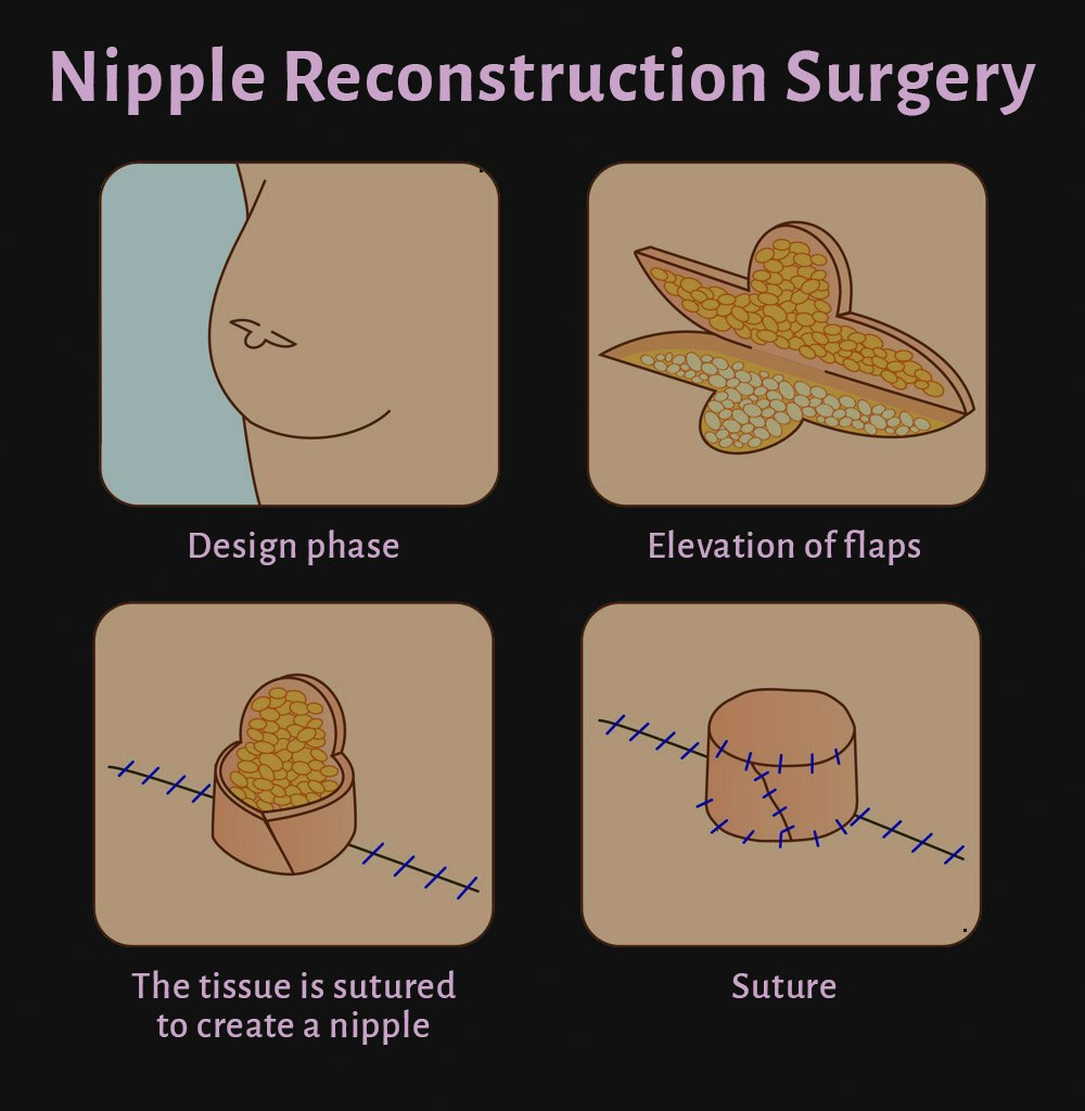 Nipple Reconstruction Diagram
