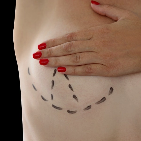 Breast with marker lines symbolizing surgical procedure