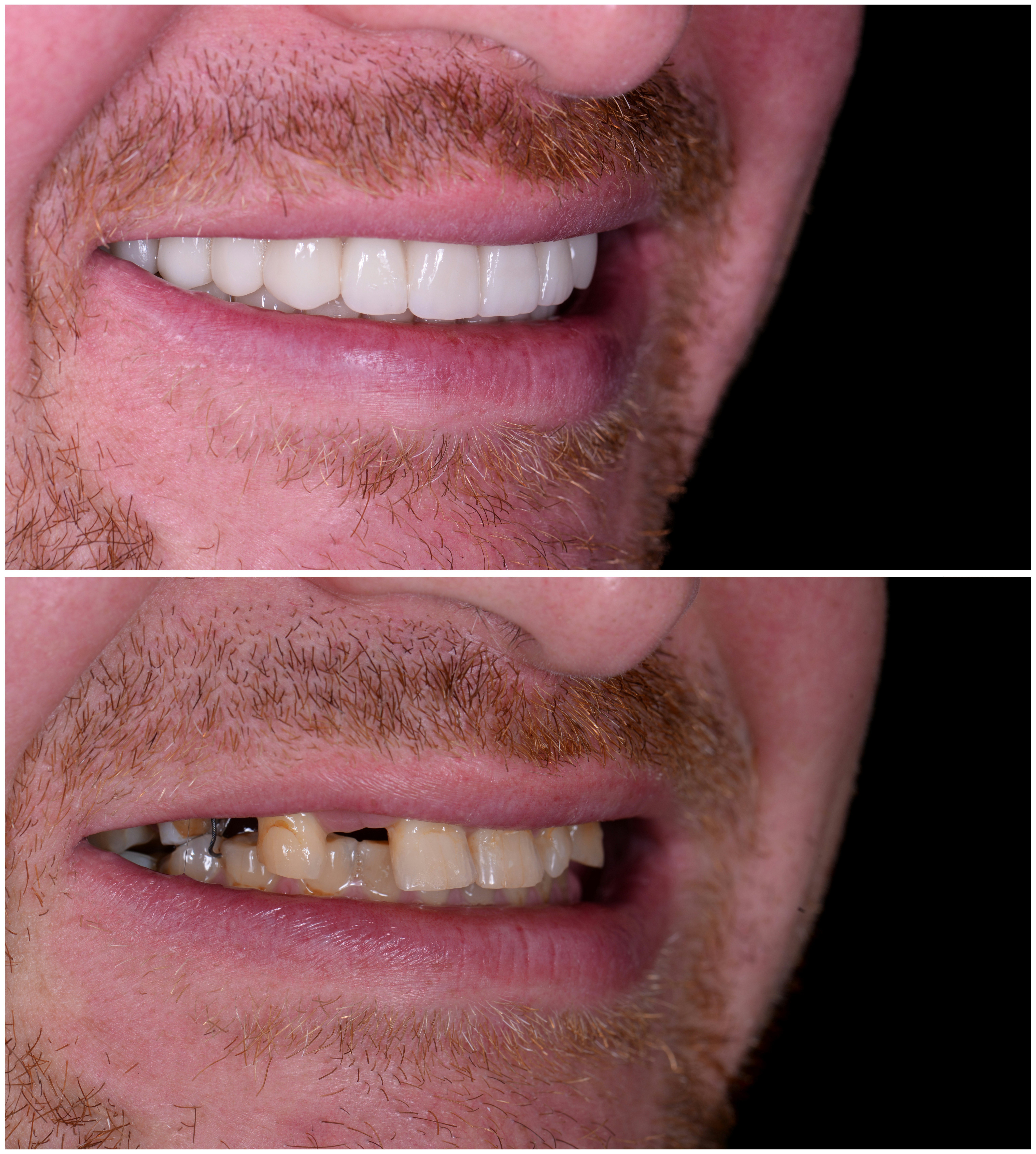 Before and after full mouth reconstruction
