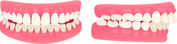 Overbite / Underbite